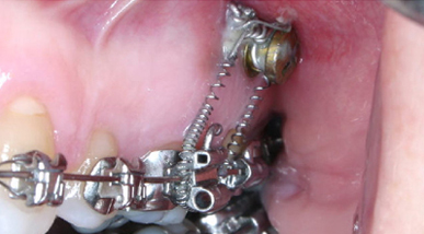 Temporary Skeletal Anchors Dr A B Hammond Orthodontics 